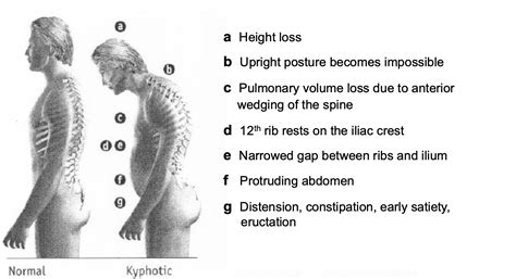 vertebral compression fracture test and measures|most common vertebral compression fracture.